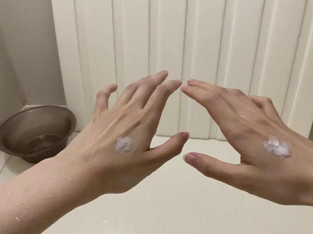 背中のステロイドの貼り薬をお風呂の中ではがして、手の甲に貼ったときの手の甲の写真。シールが10枚以上手の甲に貼ってあります