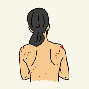 背中のケロイド