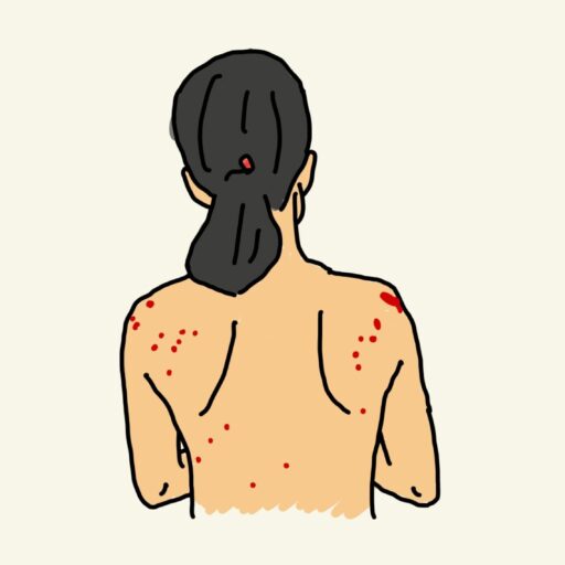 背中のケロイド