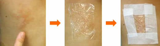 ステロイド軟膏のODT療法。密封療法とも言います。そのやり方の写真です。左から赤く腫れている肌の写真、真ん中に薬を塗ってラップをした写真、一番右にそのラップをテープで留めた写真